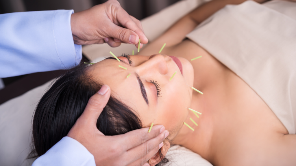 Acupuncture for migraines